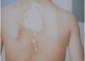 武汉白癜风的治疗时间